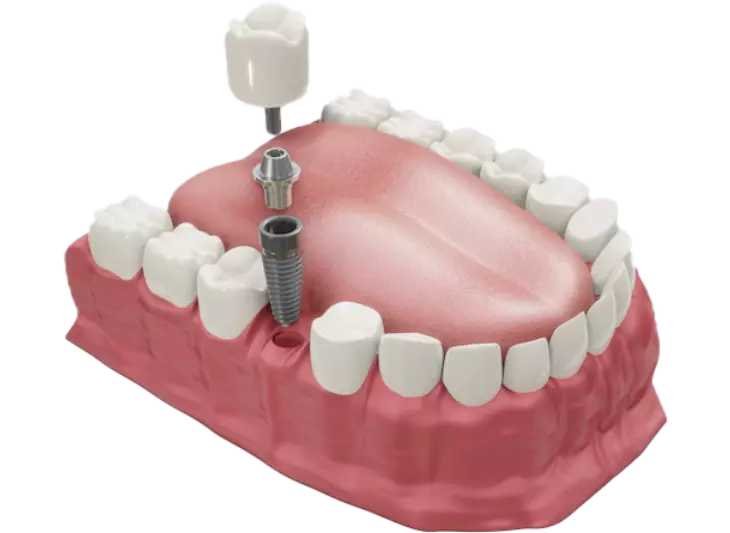 crowns dentist