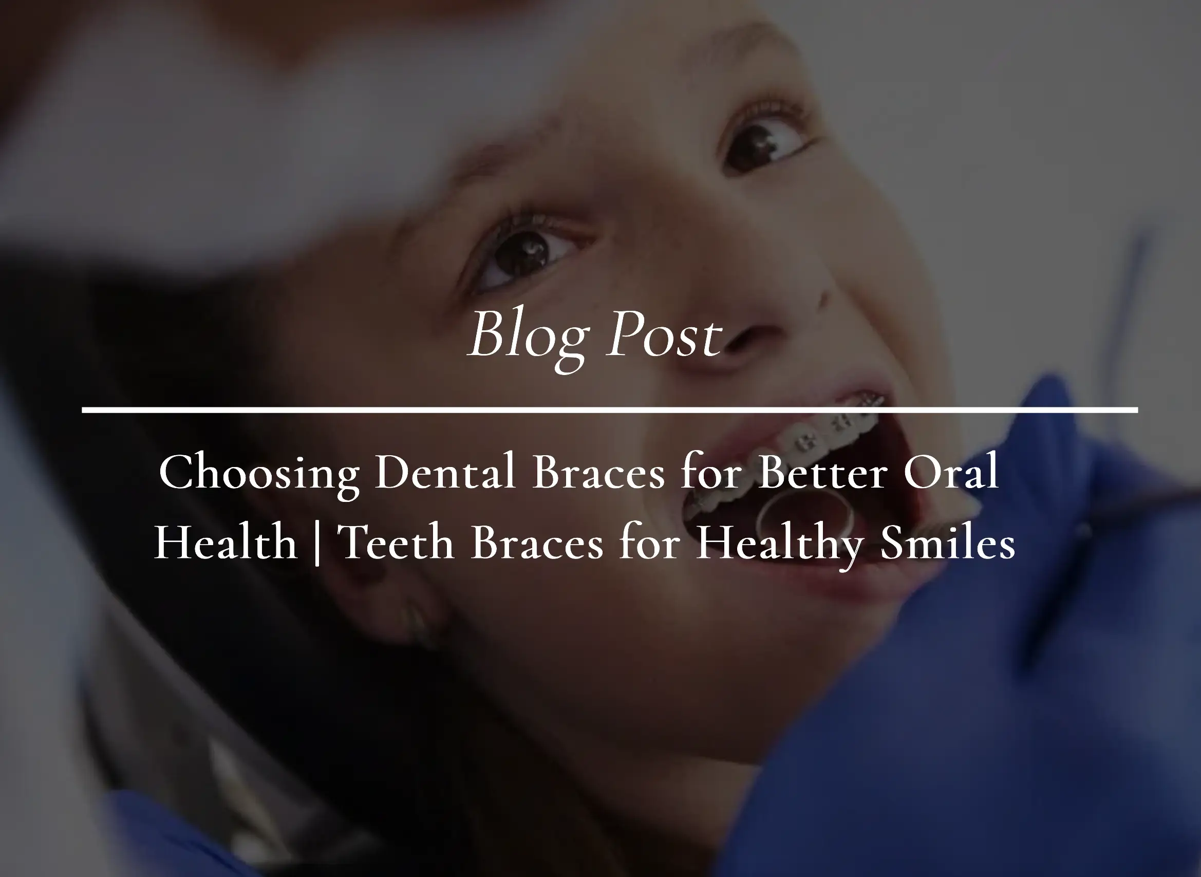 Choosing Dental Braces for Better Oral Health