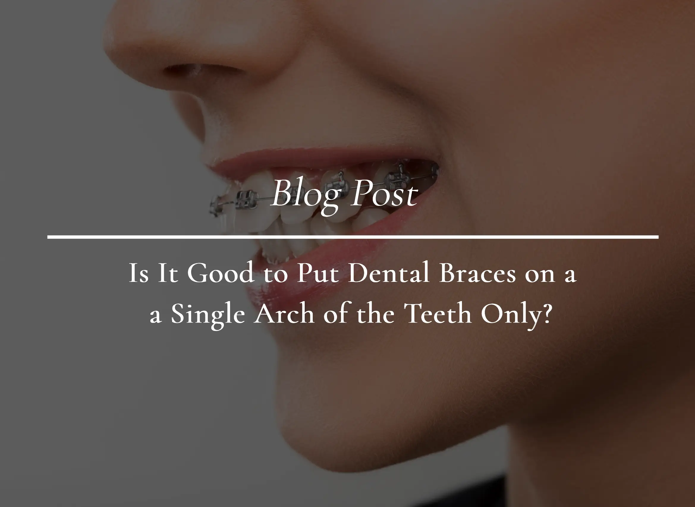 Put Dental Braces on a Single Arch of the Teeth