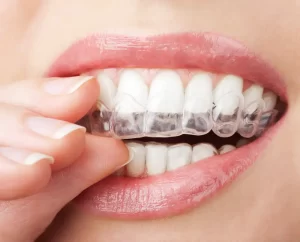 teeth whitening experts