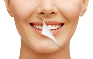 Post-Teeth Whitening Smile
